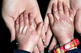 از تامین پایدار پانسمان‌های خاص بیماران پروانه‌ای نگرانی داریم