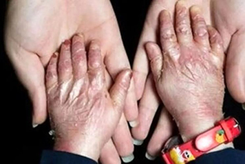 از تامین پایدار پانسمان‌های خاص بیماران پروانه‌ای نگرانی داریم